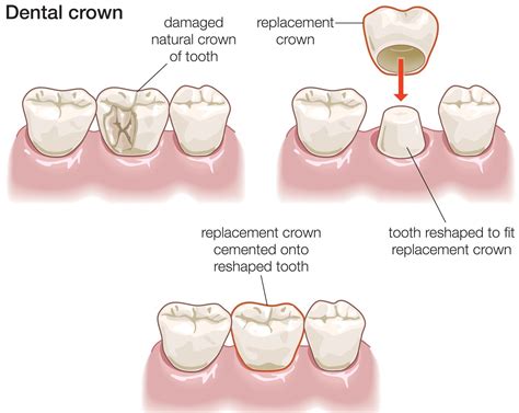 Tooth Crown Cost