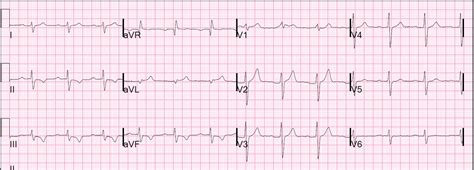 Dr. Smith's ECG Blog: New RBBB and subtle NSTEMI