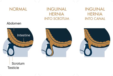 Types Of Hernia Diagram