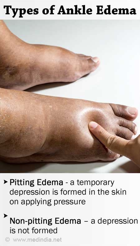 Pitting Edema VS Non-Pitting Edema: What's The Difference?, 41% OFF