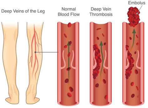 Blood clot causes, symptoms, diagnosis, prevention, prognosis & treatment