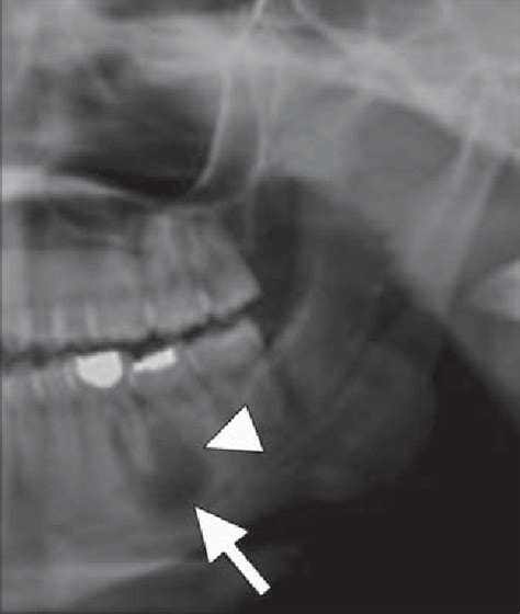 year-old woman with periapical cyst. Cropped panoramic radiograph shows... | Download Scientific ...