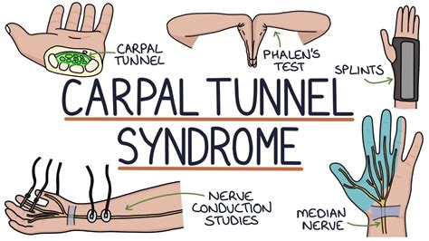 Carpal Tunnel Syndrome: Symptoms, Causes, and Treatment