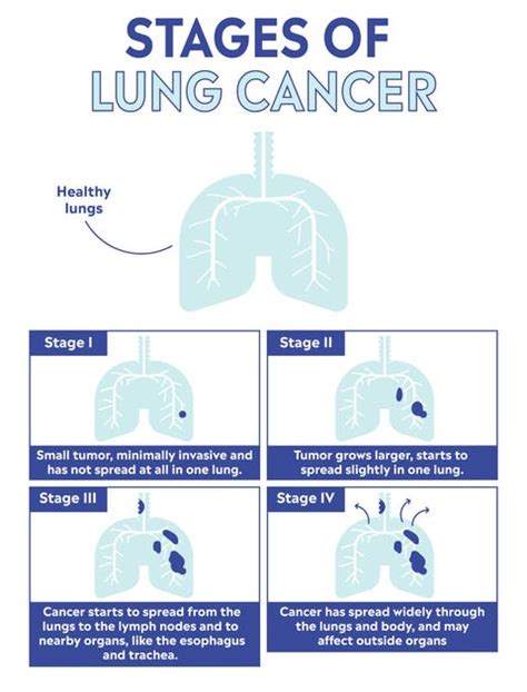 What Is Lung Cancer? Symptoms, Causes, Treatment, Prevention