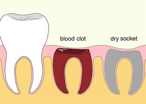 Dry Socket: Causes, Symptoms, Treatment, and Prevention