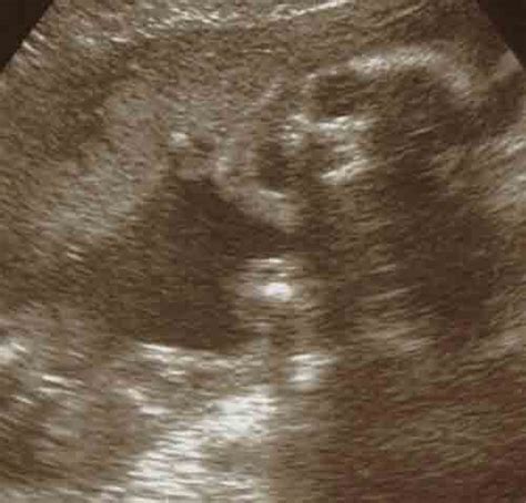 Baby Ultrasound Images - Week 22