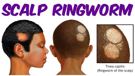 Ringworm African American