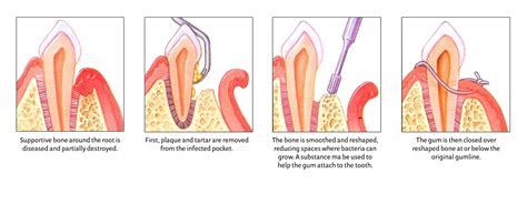 Periodontal Pocket Reduction Surgery | Tampa & New Port Richey