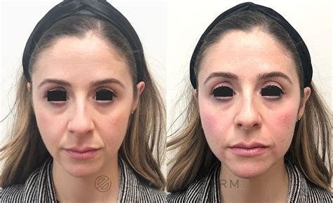 Dermal Fillers Before & After Photo Gallery | Natick, MA | Essential Dermatology