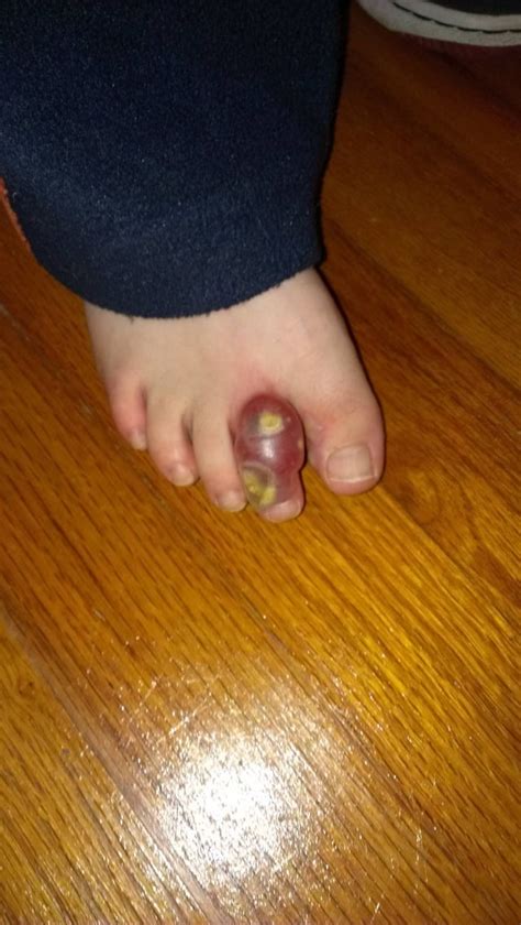 My cousin's toe after a single fire ant bite : r/WTF