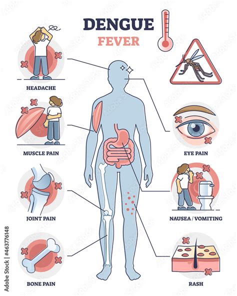 Dengue fever symptoms awareness poster, educational vector illustration diagram. Infectious ...