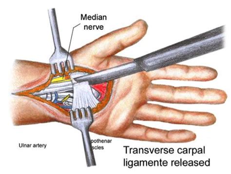 Carpal Tunnel Surgery Video | The Carpal Solution