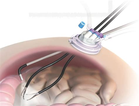 Fibroid Removal Singapore | Dr Anthony Siow