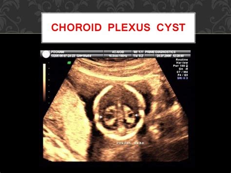 Screening for fetal aneuploidy