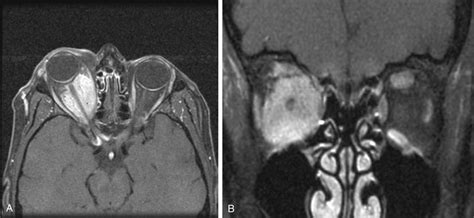 Optic Nerve and Peripheral Nerve Sheath Tumors | Ento Key