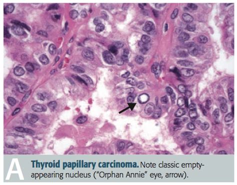 Classifying Neoplasms Flashcards | Quizlet