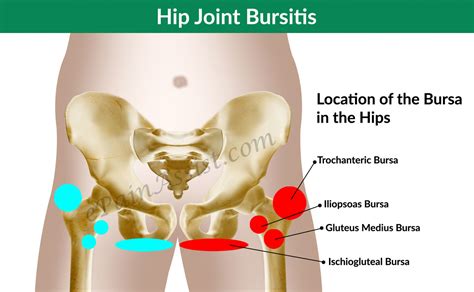 Hip Joint Bursitis & Tendinitis- Causes, Signs, Symptoms, Diagnosis, Treatment