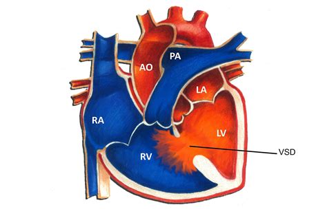 Ventricular Septal Defect Types