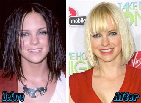 Anna Faris Plastic Surgery Before and After Photos