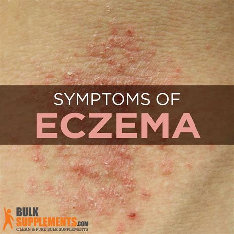 [10000印刷√] eczema causes 129239-Eczema causes and treatment