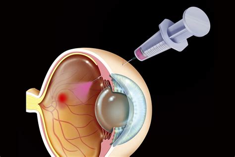 Treatment for Wet Age-Related Macular Degeneration