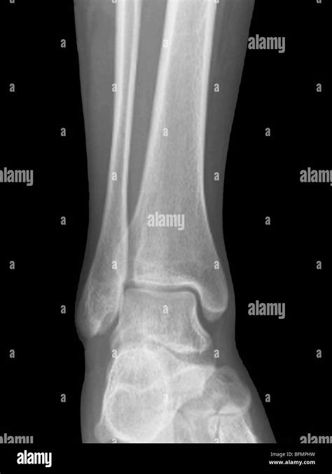 Normal ankle joint, X-ray Stock Photo - Alamy