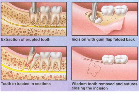 Wisdom teeth removal | News | Dentagama