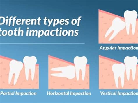 How To Take Care Of Wisdom Teeth - Treatbeyond2