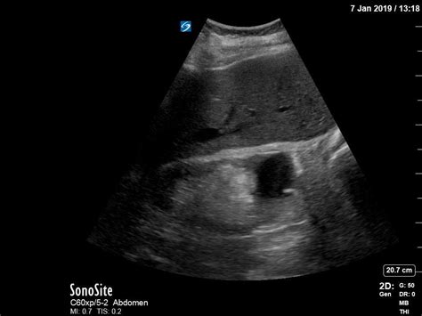 Hemorrhagic Renal Cyst - JETem