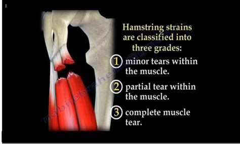 Anatomy Of An Injury Hamstring Pulls And Tears | My XXX Hot Girl