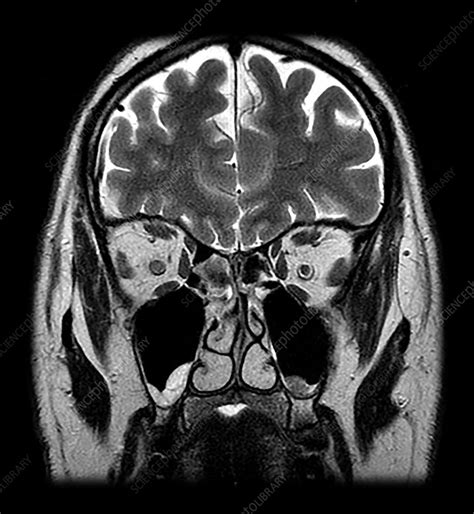 MRI Optic Neuritis - Stock Image - C043/2829 - Science Photo Library