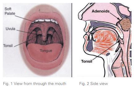 Tonsillectomy Anatomy