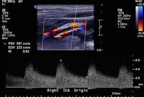 Carotid Artery Stenosis Chart Ultrasound