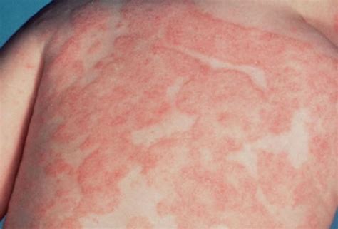 Pin on Eczema Solutions