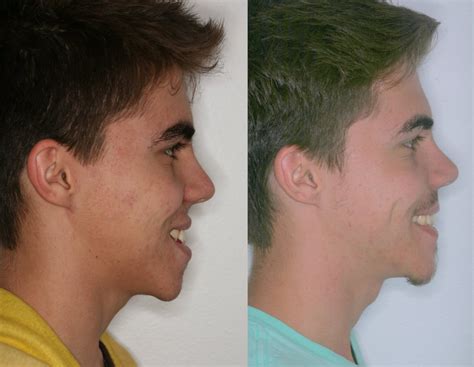 Corrective Jaw Surgery | Orthognathic Surgery | Misaligned Jaws