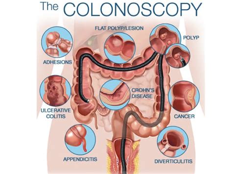 Colonoscopy - Prashant Kedia MD | Endoscopic Sleeve Gastroplasty | Gastric Sleeve Surgery ...