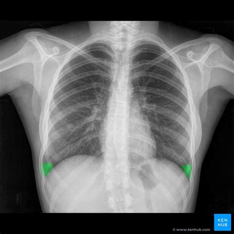 Normal Chest X Ray Pa View Female