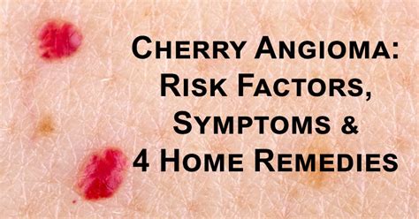 Cherry Angioma: Risk Factors, Symptoms & 4 Home Remedies - DavidWolfe.com