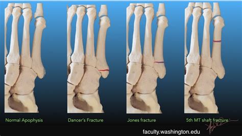 5th metatarsal fracture — Maimonides Emergency Medicine Residency