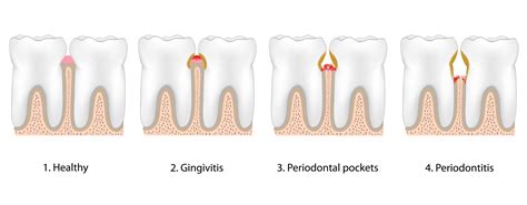 Long Island, NY Periodontal Disease and Tooth Loss: Missing Teeth and Gum Health