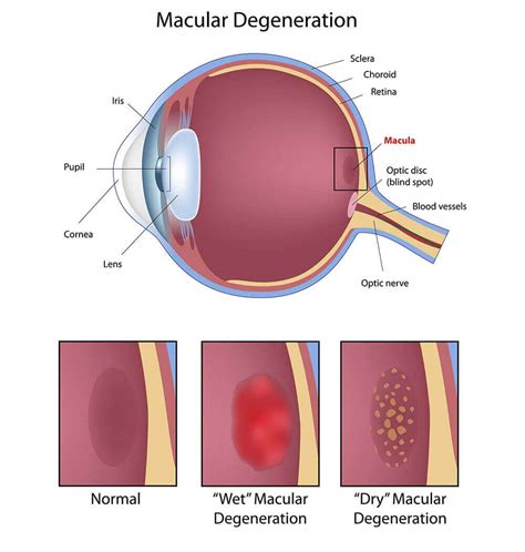 Retina Orange County | Macular Degeneration | Harvard Eye