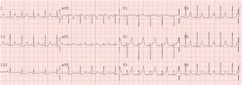 Dr. Smith's ECG Blog: Slightly Peaked T-waves, What is it?