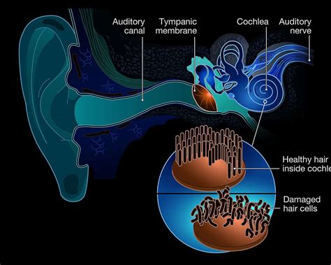 Tinnitus | Active Life Hearing