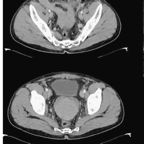 (PDF) Hemoperitoneum: A rare complication of hemorrhoid treatment