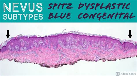 Spitz Nevus Histopathology | SexiezPicz Web Porn