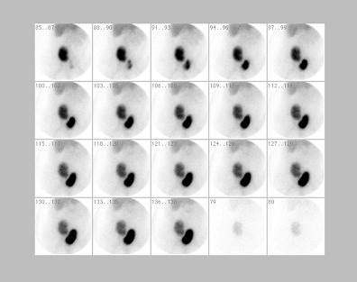 NUCLEAR MEDICINE