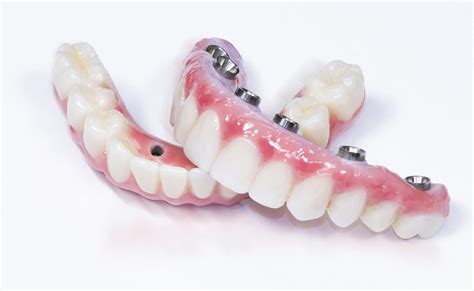 Dental Implants | Full Mouth Dental Implants