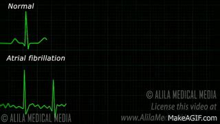 Atrial Fibrillation Anatomy, ECG and Stroke, Animation. on Make a GIF