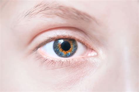 Central Heterochromia: Types and Causes | MyVision.org