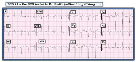 Stemi Ecg Examples